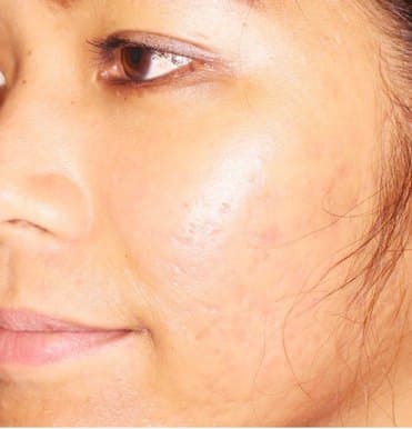 Acne-scar remodeling — after