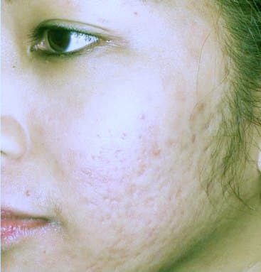 Acne-scar remodeling — before