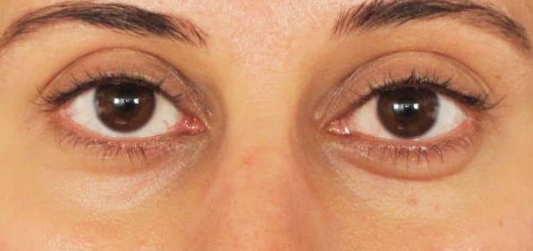 Under-eye rejuvenation — after