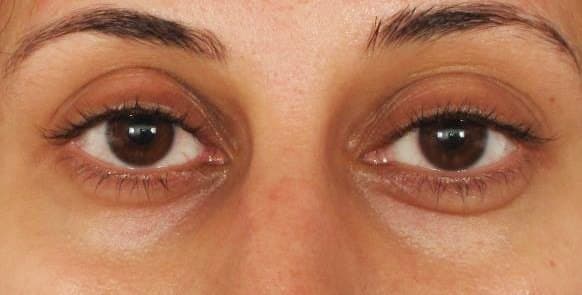 Under-eye rejuvenation — before