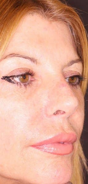 Skin glow & fine lines — after