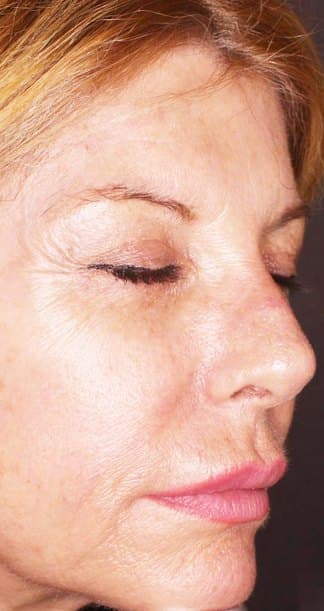 Skin glow & fine lines — before
