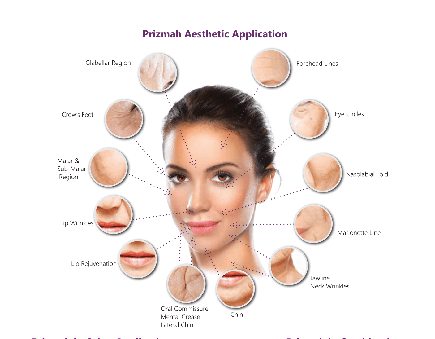 Prizmah aesthetic treatment zones across the face