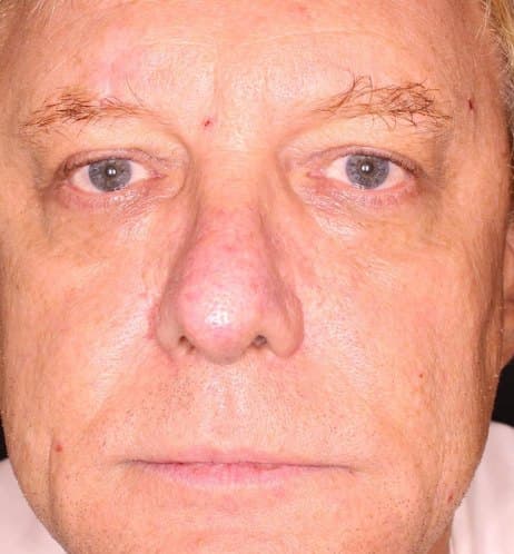 Same patient after Prizmah facial rejuvenation — brighter, firmer, more even skin