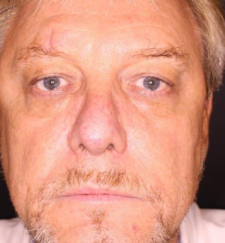 Male patient before Prizmah facial rejuvenation — dull, uneven skin